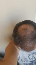 esteworld-istanbul-clinic-turkey (18)