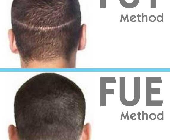 fut-hair-transplant