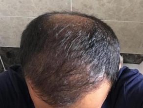 hair-implant-istanbul (13)