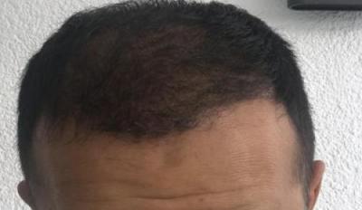 hair-implant-istanbul (15)