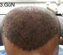 hair-implant-istanbul (2)