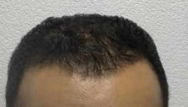 hair-implant-istanbul (21)