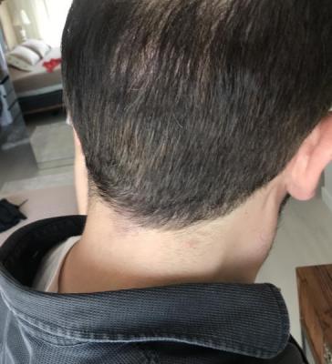 hair-implant-turkey-istanbul (26)