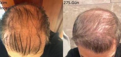 hair-implant-turkey-istanbul (32)