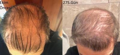hair-implant-turkey-istanbul (32)