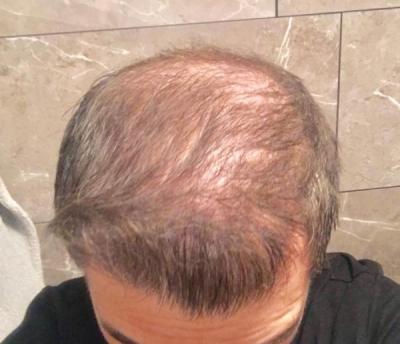 hair-implant-turkey-istanbul (33)