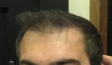 hair-implant-turkey-istanbul (8)