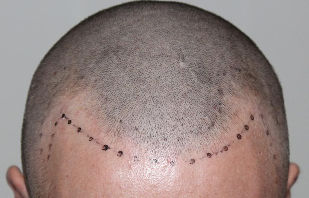hair-transplant-1600-grafts (9)