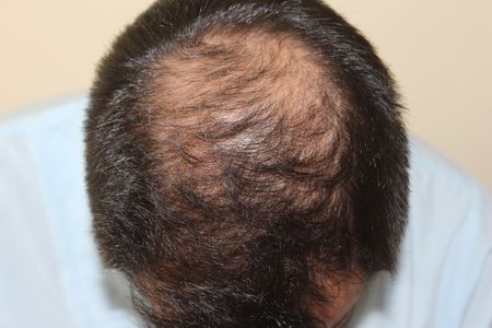 hair-transplant-2000-grafts (10)
