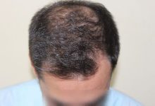 hair-transplant-2000-grafts (13)