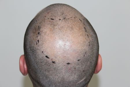 hair-transplant-2000-grafts (16)