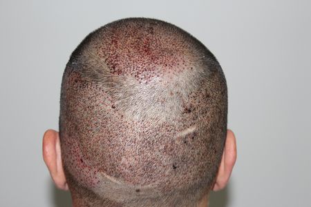 hair-transplant-2000-grafts (17)