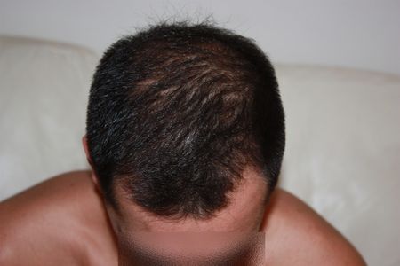 hair-transplant-2000-grafts (3)