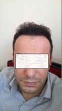 hair-transplant-in-istanbul (12)