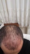 hair-transplant-in-istanbul (4)