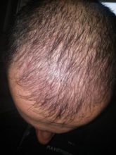 hair-transplant-in-istanbul (5)