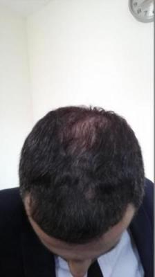 hair-transplant-in-istanbul (8)