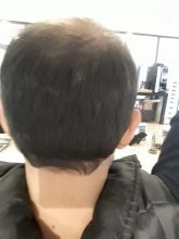 hair-transplant-in-turkey-istanbul (1)