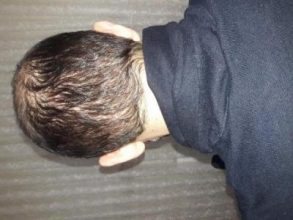 hair-transplant-in-turkey-istanbul (10)