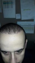 hair-transplant-in-turkey-istanbul (17)