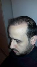 hair-transplant-in-turkey-istanbul (18)