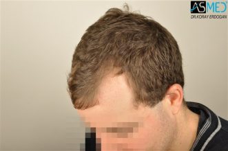 hair-transplant-istanbul (1)