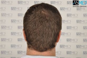 hair-transplant-istanbul (12)