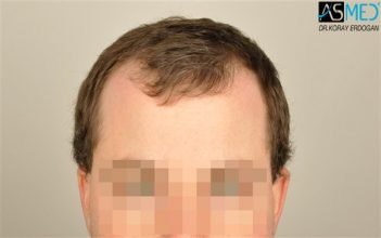 hair-transplant-istanbul (14)