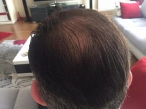 hair-transplant-istanbul (16)