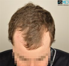 hair-transplant-istanbul (17)
