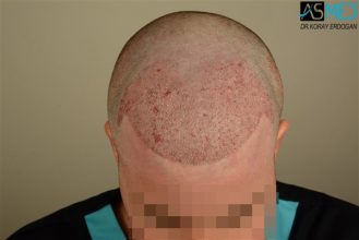 hair-transplant-istanbul (18)
