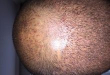 hair-transplant-istanbul (2)
