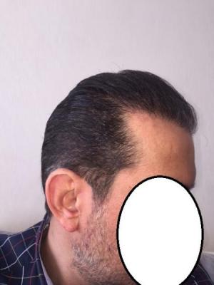 hair-transplant-istanbul (21)