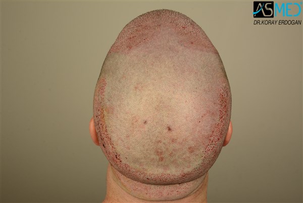 hair-transplant-istanbul (5)
