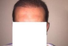 hair-transplant-istanbul (9)