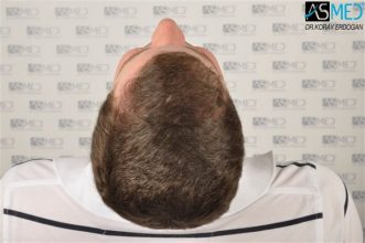 hair-transplant-istanbul (9)