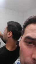 hair-transplant-istanbul-arenamed (12)