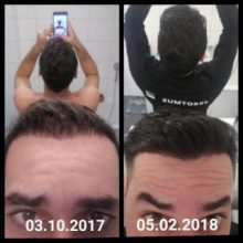 hair-transplant-istanbul-arenamed (15)