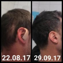 hair-transplant-istanbul-arenamed (17)