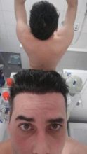 hair-transplant-istanbul-arenamed (19)