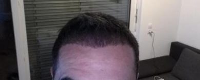 hair-transplant-istanbul-arenamed (8)