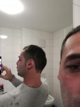 hair-transplant-istanbul-arenamed (9)