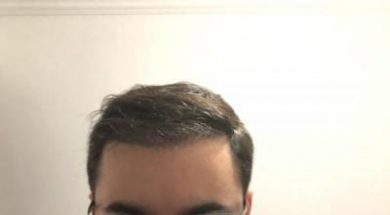 hair-transplant-price-turkey (1)