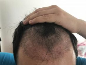 hair-transplant-price-turkey (11)