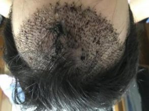 hair-transplant-price-turkey (6)