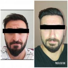 hair-transplant-turkey-istanbul (1)