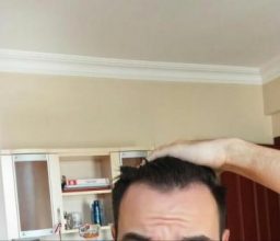 hair-transplant-turkey-istanbul (2)