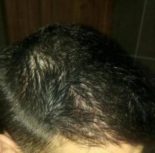 hair-transplant-turkey-istanbul (21)