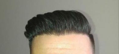 hair-transplant-turkey-istanbul (26)