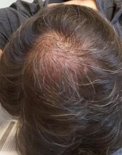 after-hair-transplant (1)